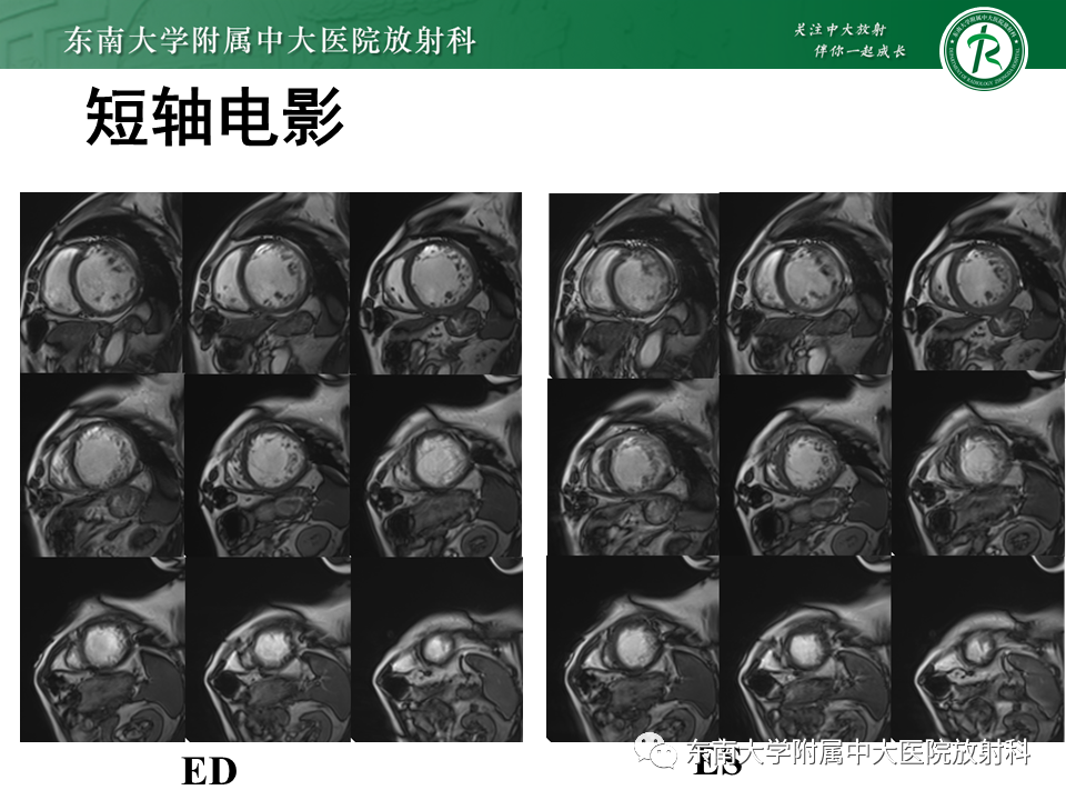 【PPT】心肌致密化不全-20