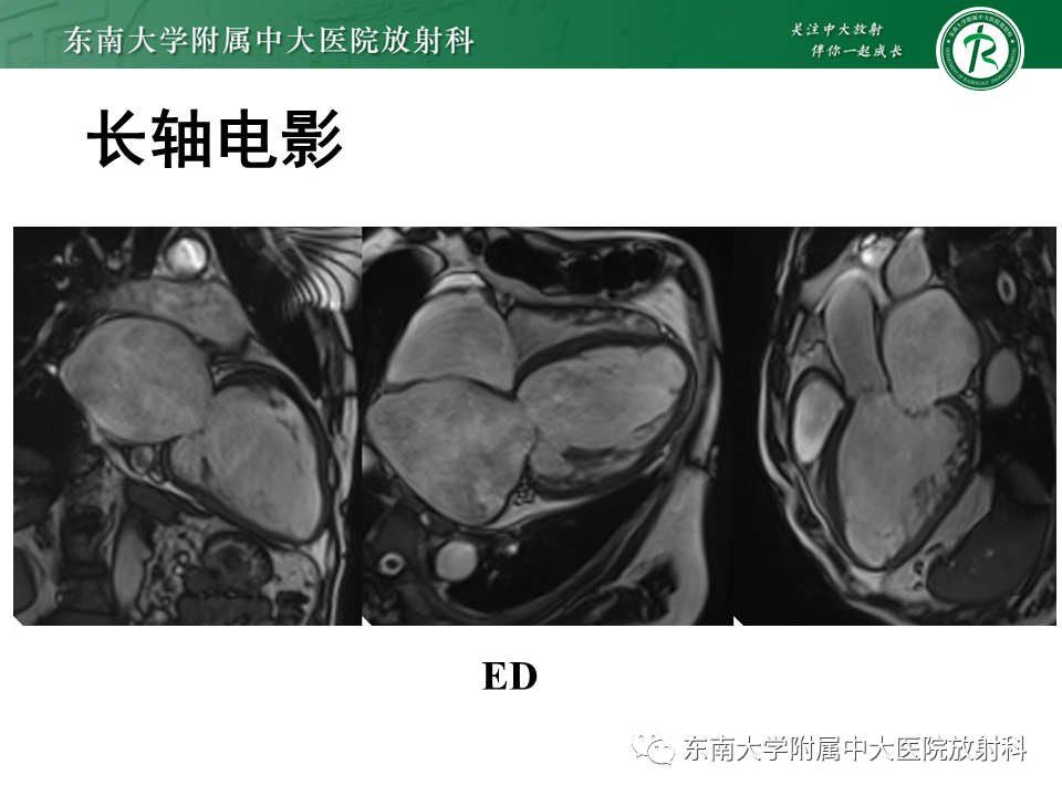 【PPT】心肌致密化不全-21