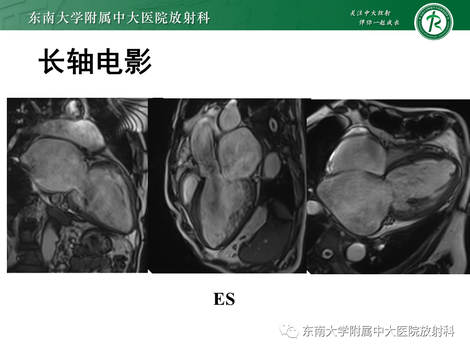 【PPT】心肌致密化不全-22