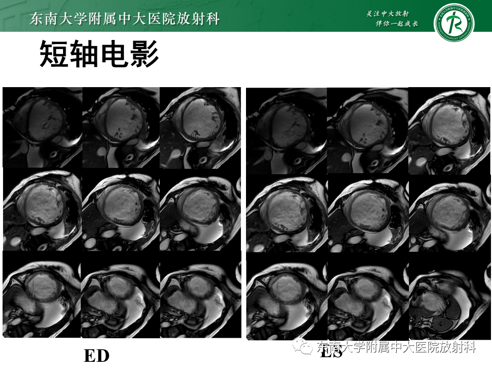 【PPT】心肌致密化不全-26