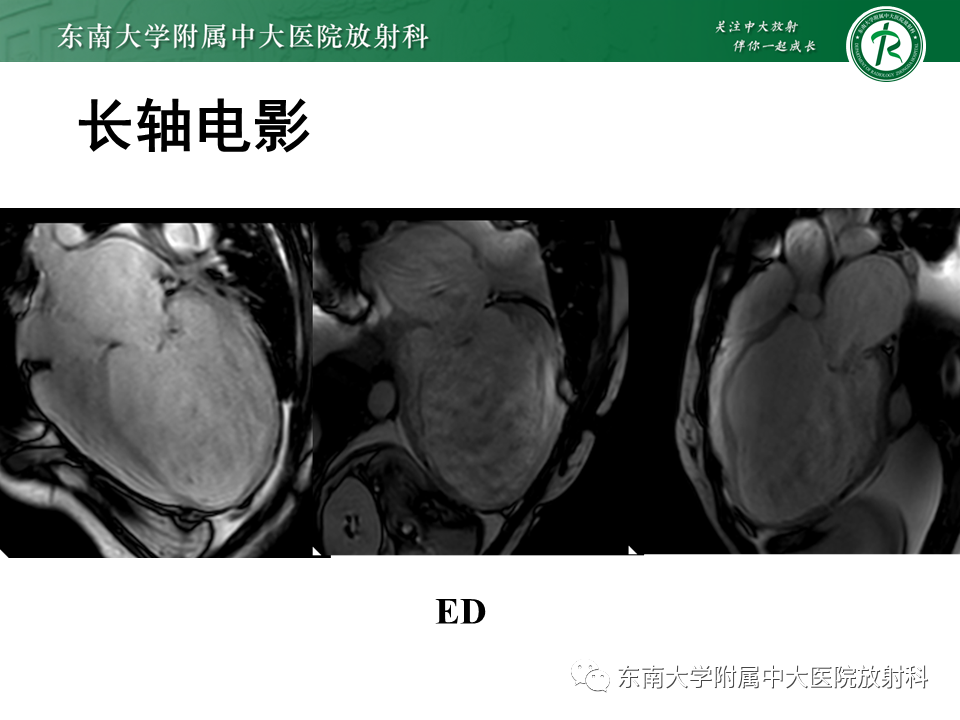 【PPT】心肌致密化不全-27