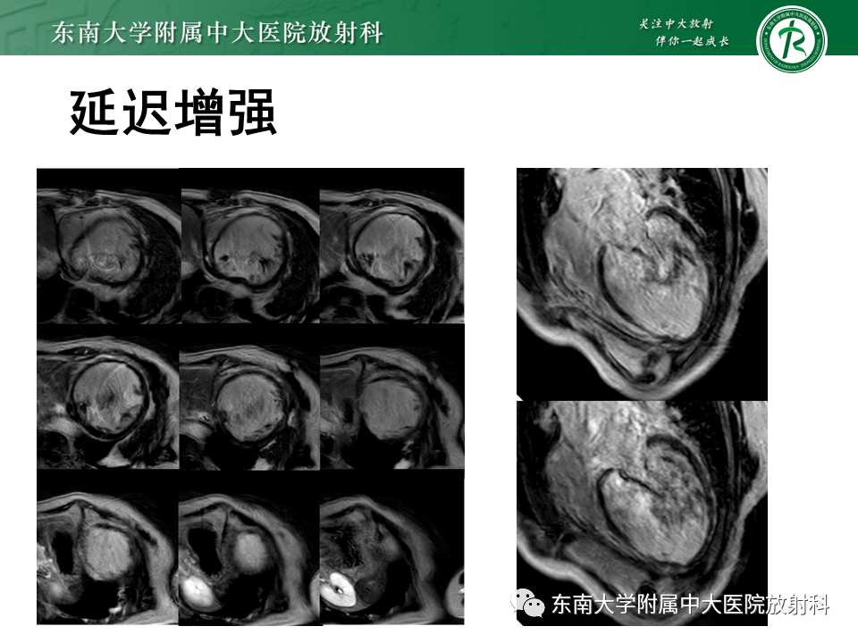 【PPT】心肌致密化不全-28