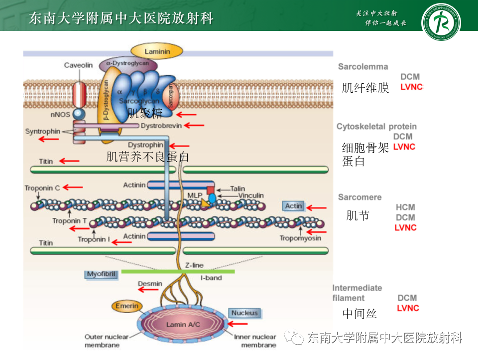 【PPT】心肌致密化不全-37