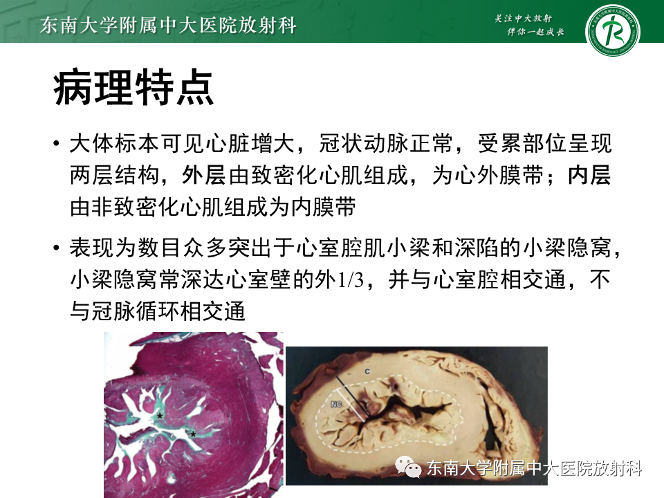 【PPT】心肌致密化不全-39