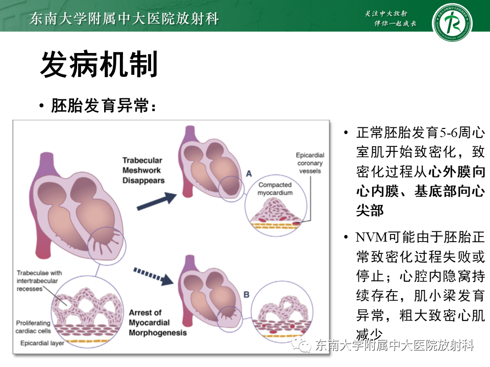【PPT】心肌致密化不全-35