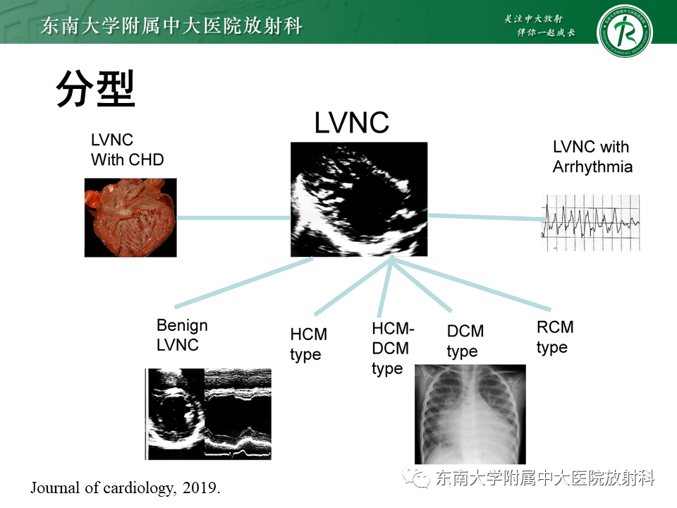 【PPT】心肌致密化不全-42