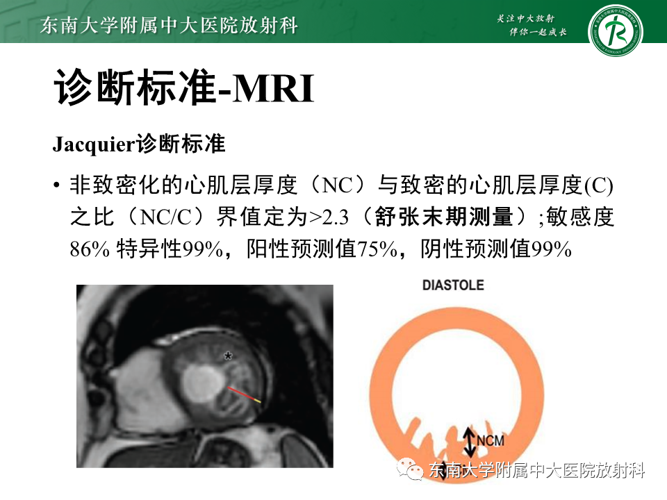 【PPT】心肌致密化不全-46