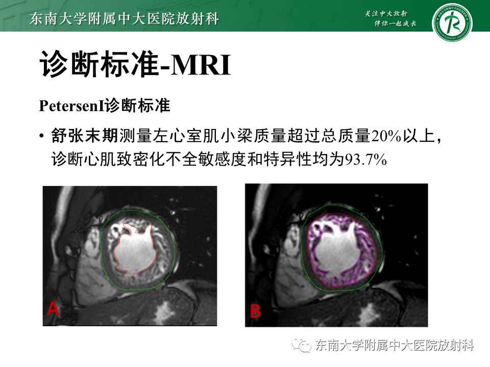 【PPT】心肌致密化不全-47