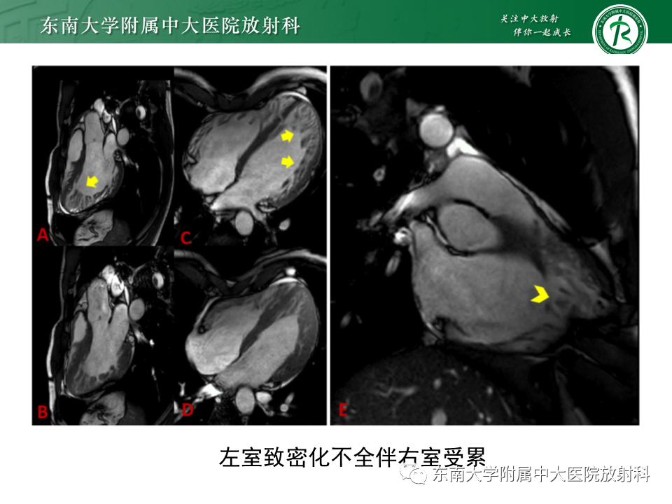 【PPT】心肌致密化不全-49