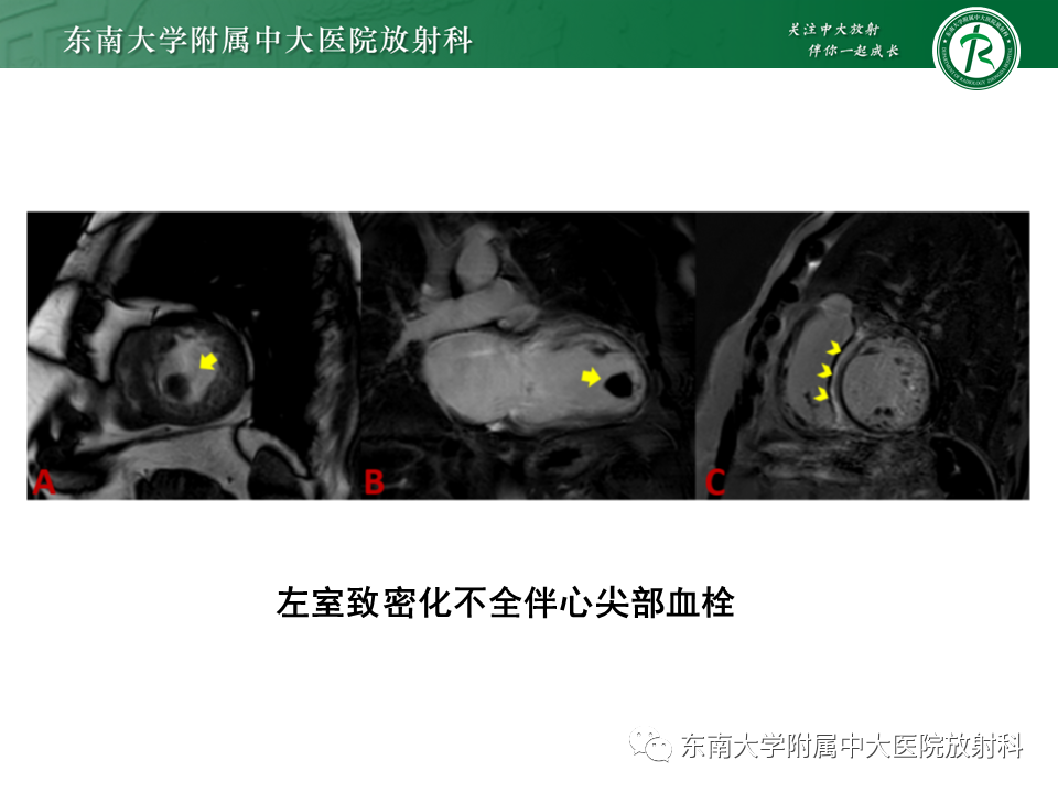 【PPT】心肌致密化不全-50