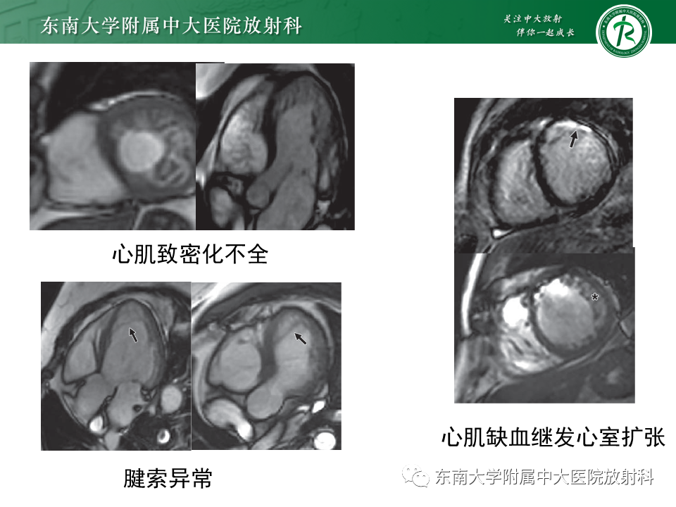 【PPT】心肌致密化不全-55
