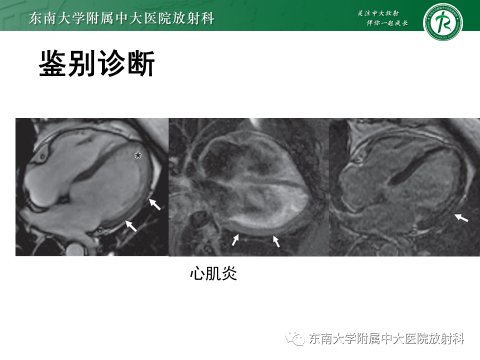 【PPT】心肌致密化不全-56