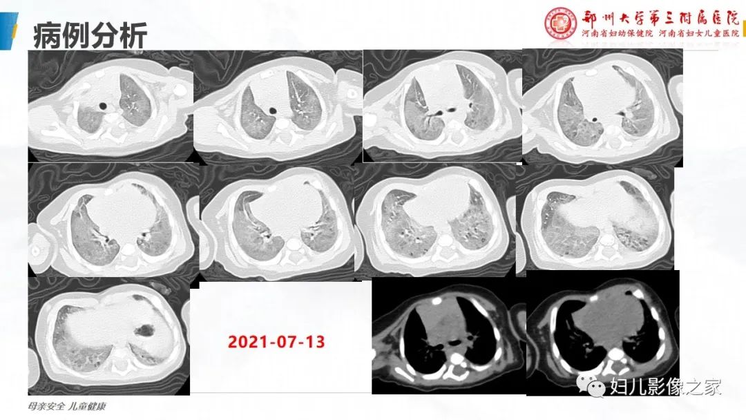 【PPT】肺泡蛋白沉积症的影像诊断-4