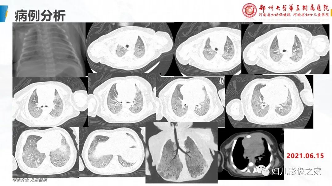 【PPT】肺泡蛋白沉积症的影像诊断-3