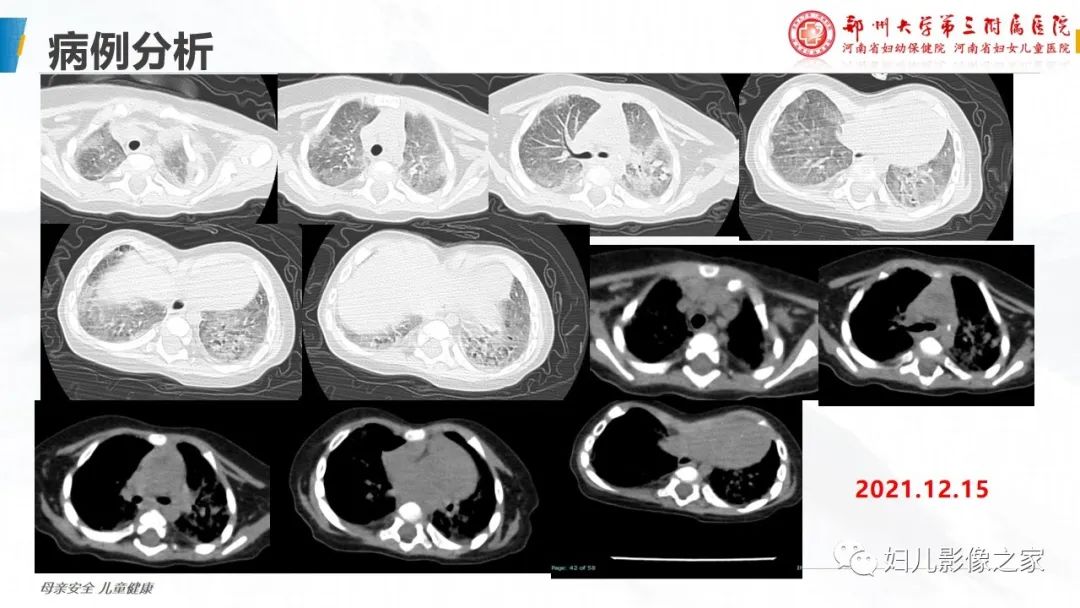 【PPT】肺泡蛋白沉积症的影像诊断-5