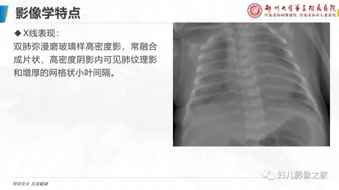 【PPT】肺泡蛋白沉积症的影像诊断-12