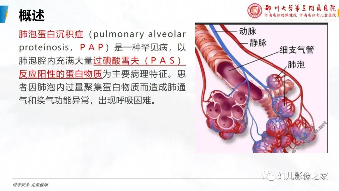 【PPT】肺泡蛋白沉积症的影像诊断-8