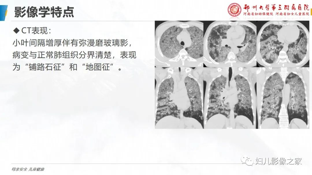【PPT】肺泡蛋白沉积症的影像诊断-13