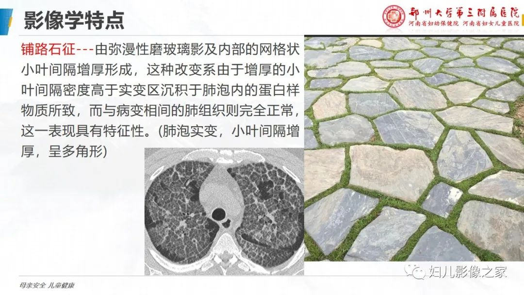 【PPT】肺泡蛋白沉积症的影像诊断-14