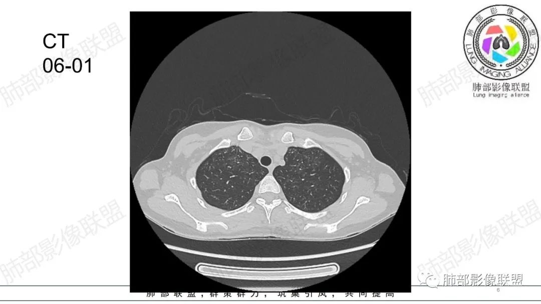 【病例】肺部弥漫大B淋巴瘤病例思考及启示-6