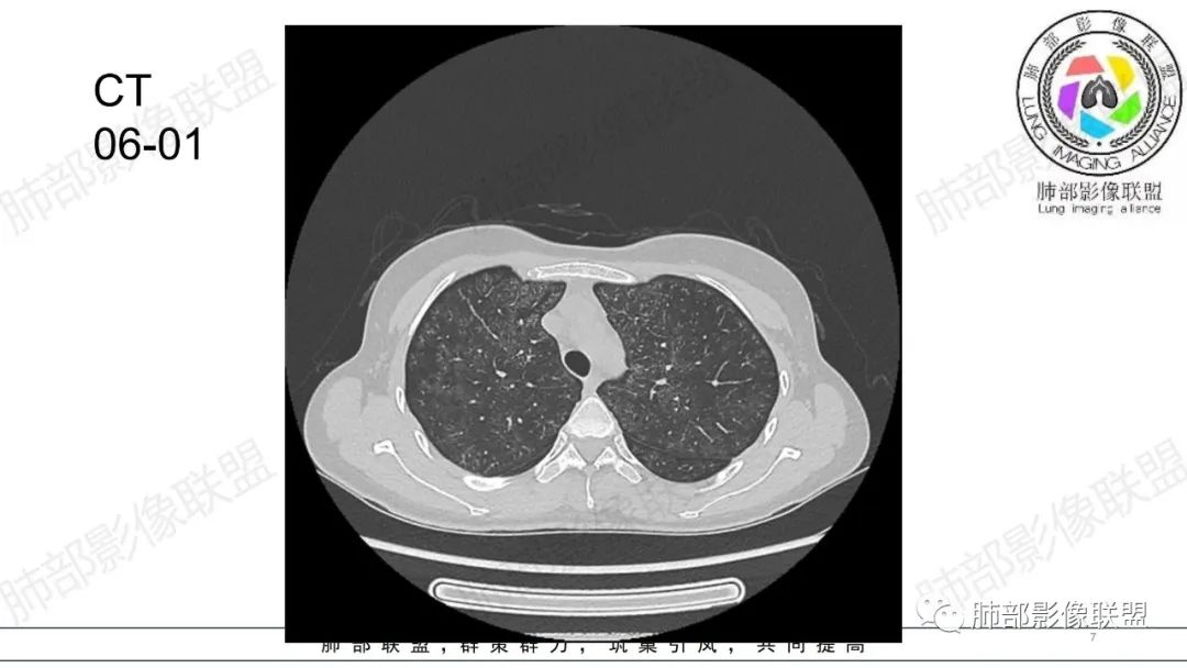 【病例】肺部弥漫大B淋巴瘤病例思考及启示-7