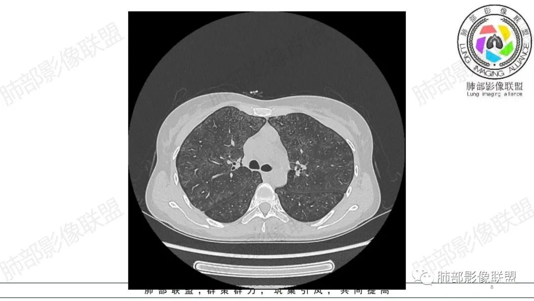 【病例】肺部弥漫大B淋巴瘤病例思考及启示-8