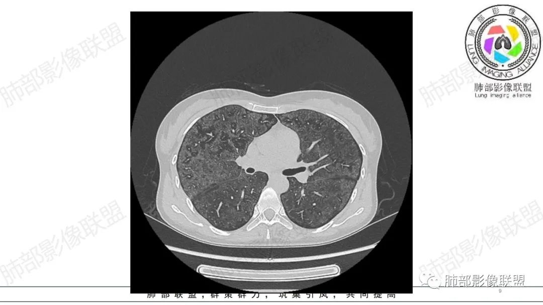 【病例】肺部弥漫大B淋巴瘤病例思考及启示-9