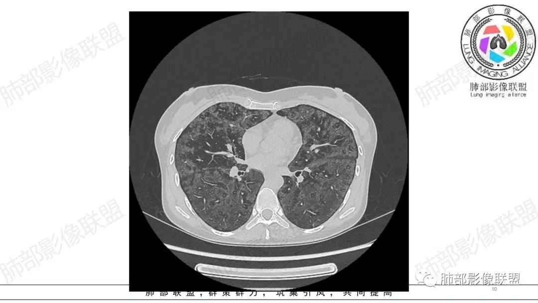 【病例】肺部弥漫大B淋巴瘤病例思考及启示-10