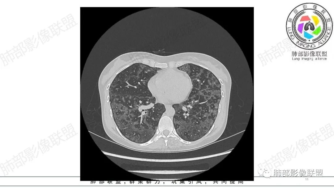 【病例】肺部弥漫大B淋巴瘤病例思考及启示-11
