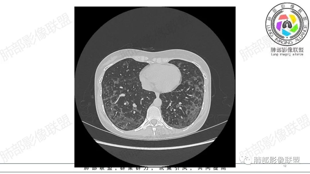 【病例】肺部弥漫大B淋巴瘤病例思考及启示-12