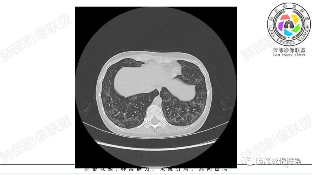 【病例】肺部弥漫大B淋巴瘤病例思考及启示-13