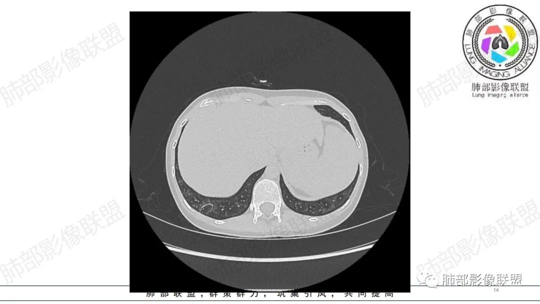 【病例】肺部弥漫大B淋巴瘤病例思考及启示-14
