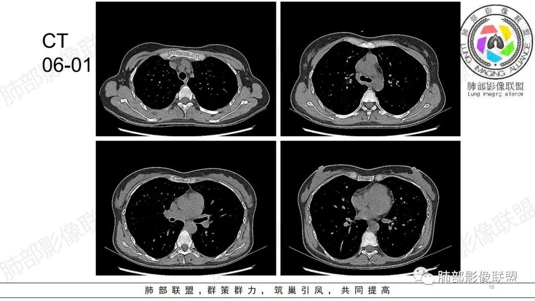 【病例】肺部弥漫大B淋巴瘤病例思考及启示-15
