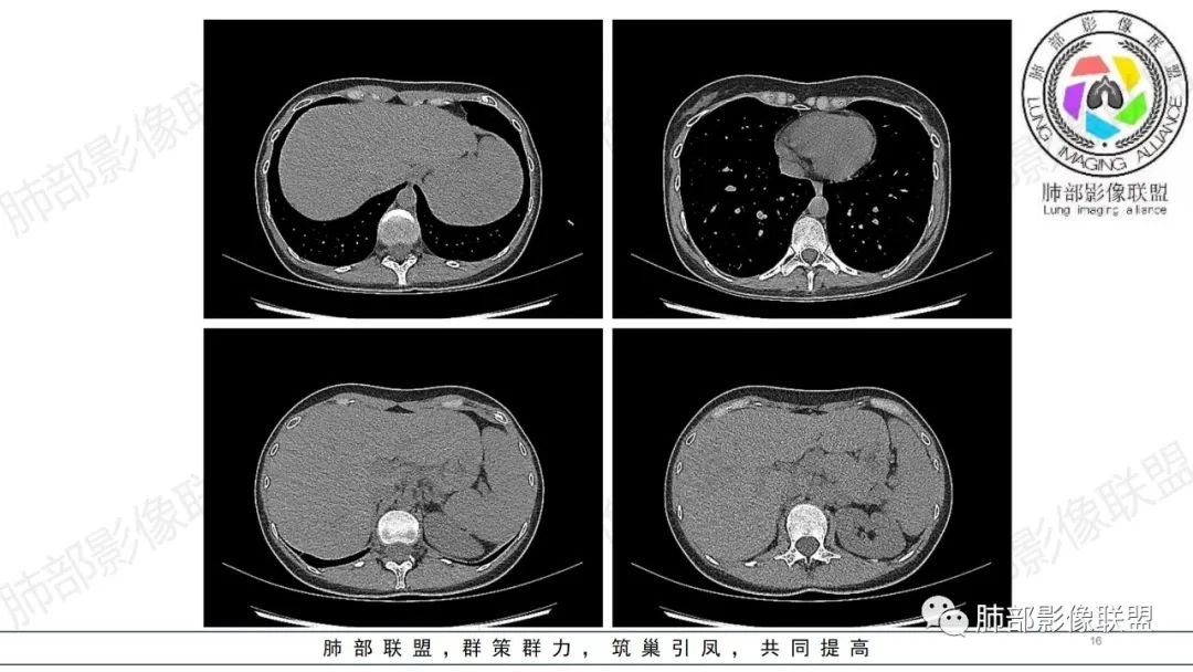 【病例】肺部弥漫大B淋巴瘤病例思考及启示-16