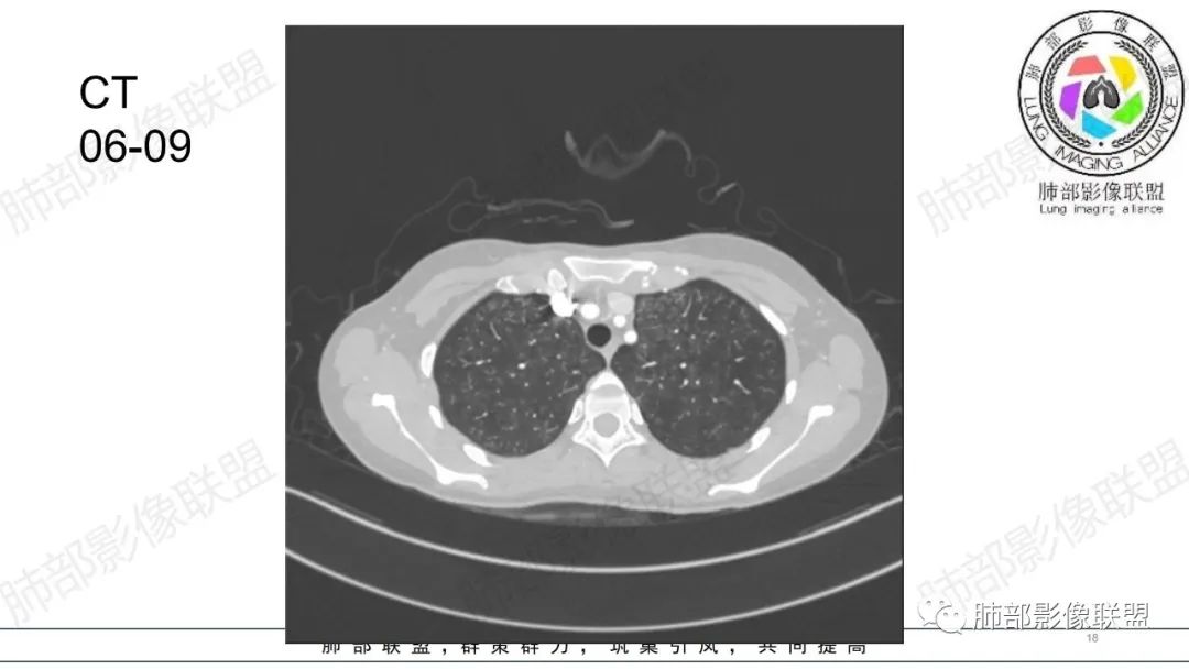 【病例】肺部弥漫大B淋巴瘤病例思考及启示-18
