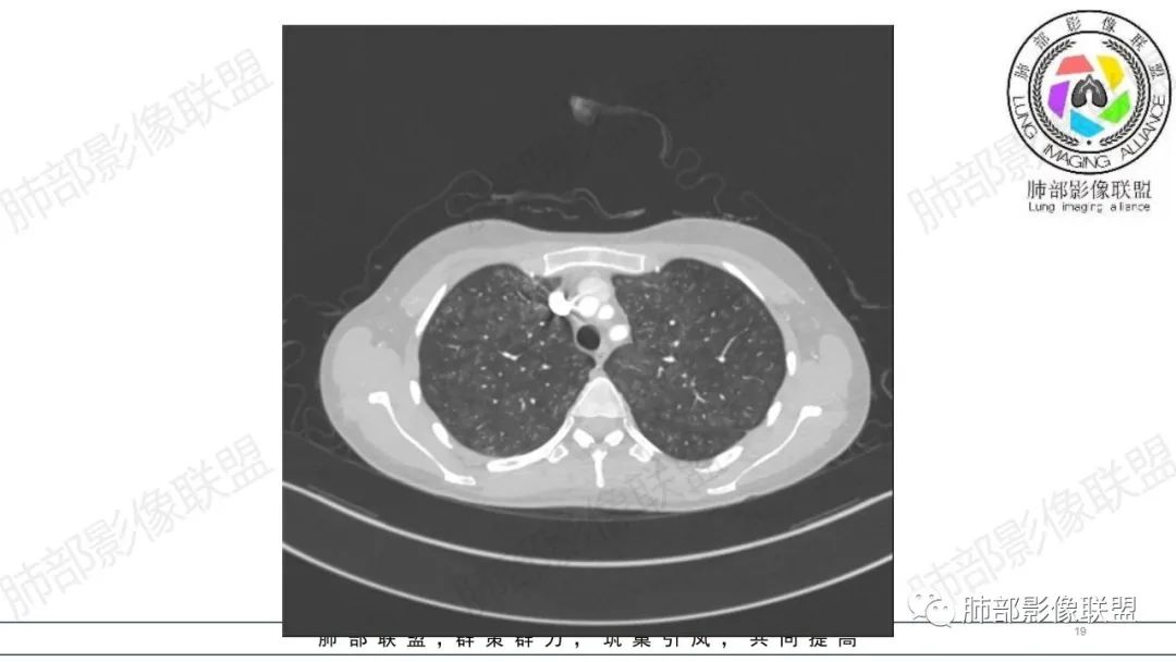 【病例】肺部弥漫大B淋巴瘤病例思考及启示-19
