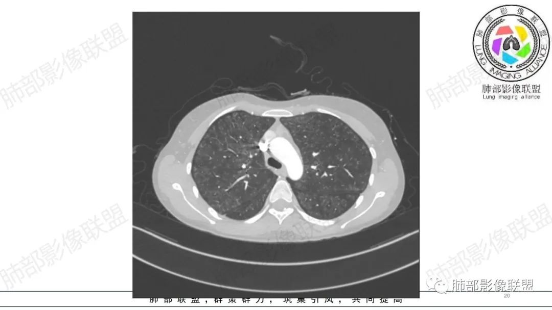 【病例】肺部弥漫大B淋巴瘤病例思考及启示-20