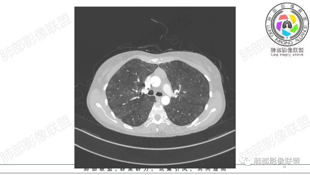 【病例】肺部弥漫大B淋巴瘤病例思考及启示-21