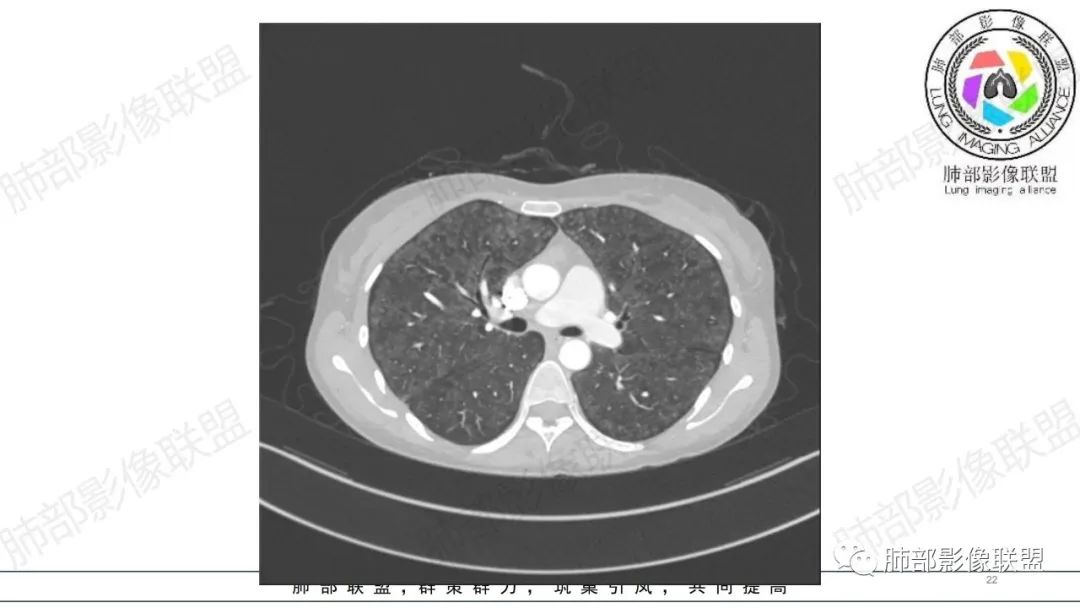 【病例】肺部弥漫大B淋巴瘤病例思考及启示-22
