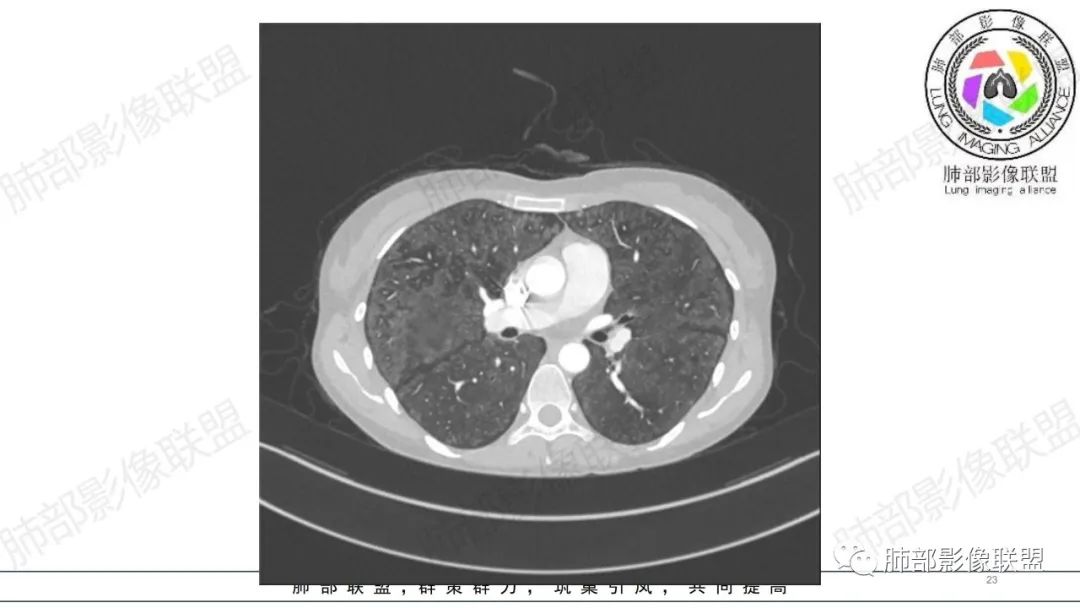 【病例】肺部弥漫大B淋巴瘤病例思考及启示-23