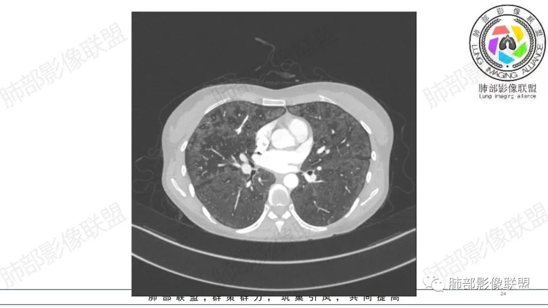 【病例】肺部弥漫大B淋巴瘤病例思考及启示-24