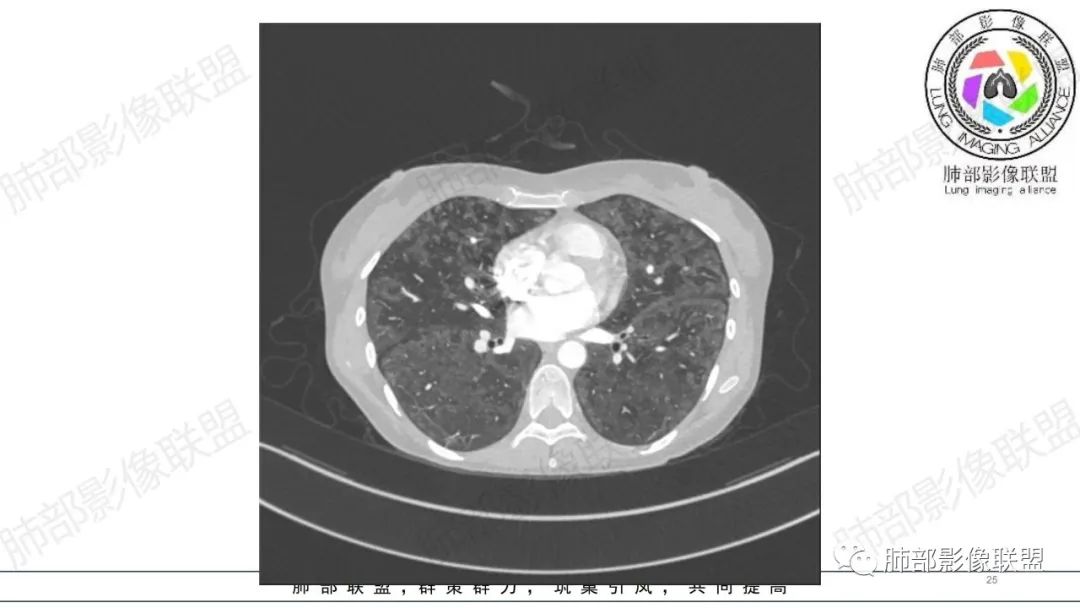 【病例】肺部弥漫大B淋巴瘤病例思考及启示-25