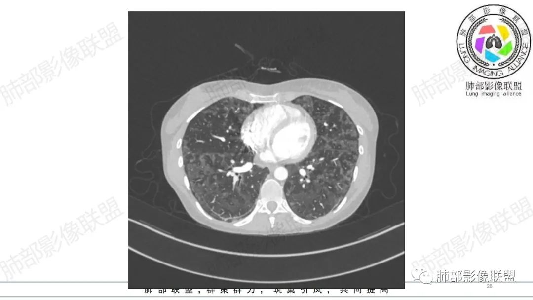 【病例】肺部弥漫大B淋巴瘤病例思考及启示-26