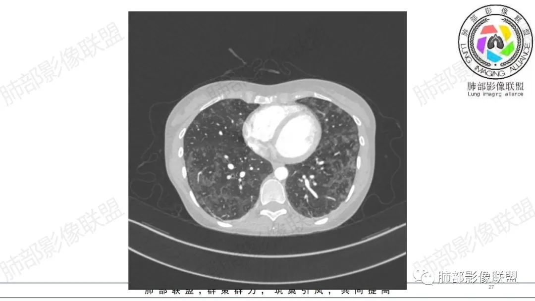 【病例】肺部弥漫大B淋巴瘤病例思考及启示-27