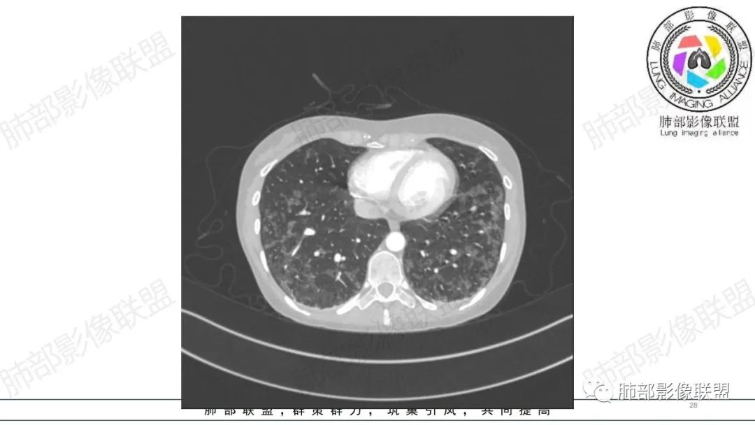 【病例】肺部弥漫大B淋巴瘤病例思考及启示-28