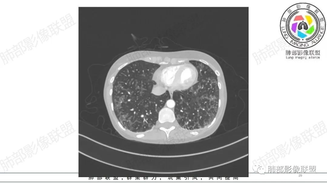 【病例】肺部弥漫大B淋巴瘤病例思考及启示-29