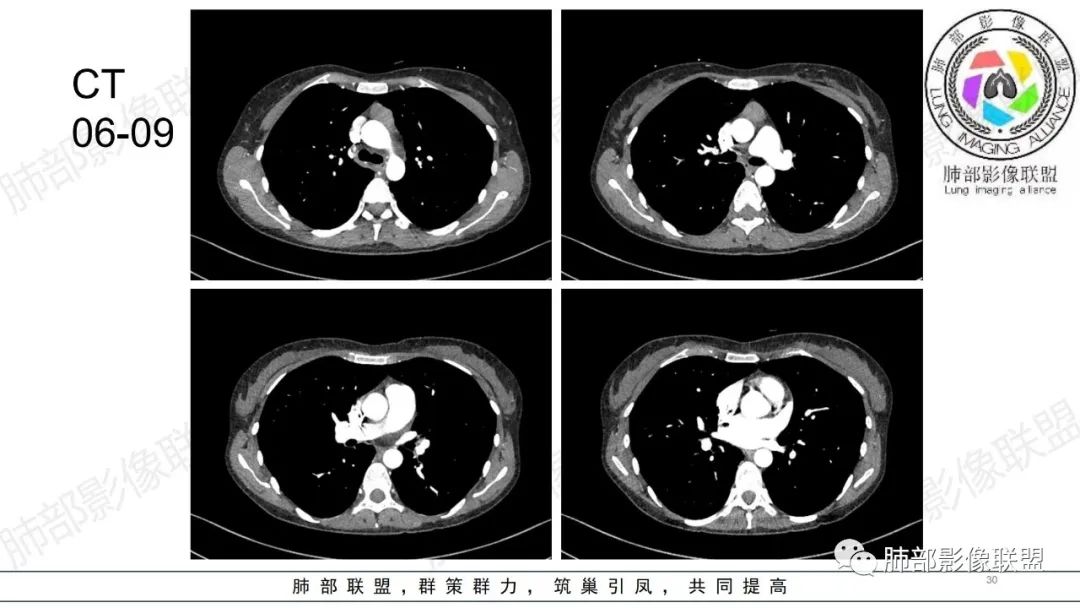 【病例】肺部弥漫大B淋巴瘤病例思考及启示-30
