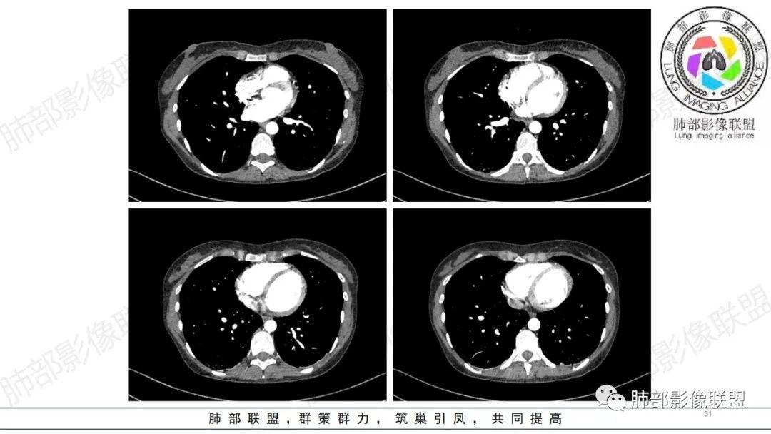 【病例】肺部弥漫大B淋巴瘤病例思考及启示-31