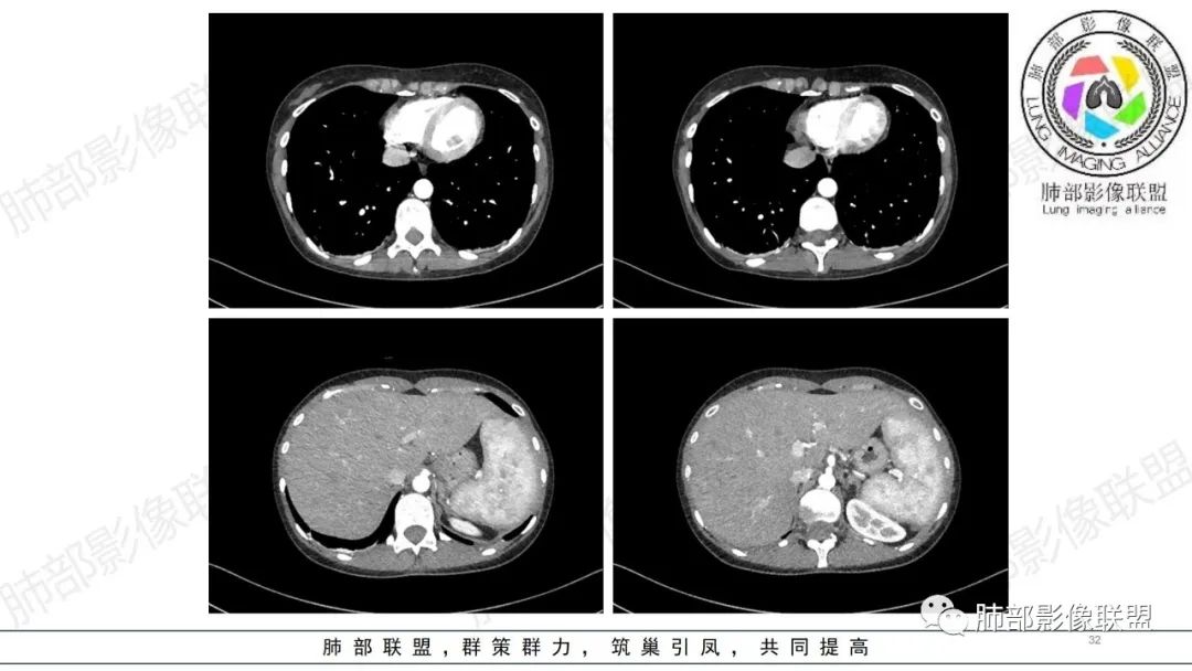 【病例】肺部弥漫大B淋巴瘤病例思考及启示-32