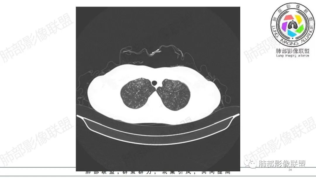 【病例】肺部弥漫大B淋巴瘤病例思考及启示-34